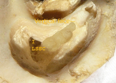 Cortical Mastoidectomy